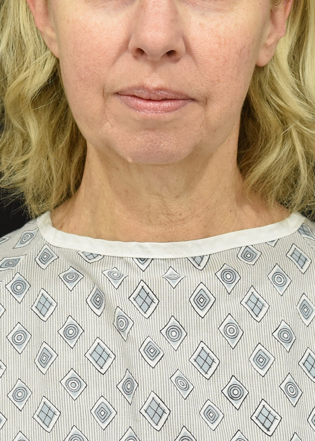 Neck Lift Patient 16 - Set 1 - Before